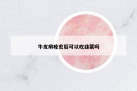 牛皮癬痊愈后可以吃韭菜嗎