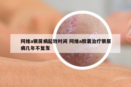 阿維a銀屑病起效時間 阿維a膠囊治療銀屑病幾年不復(fù)發(fā)