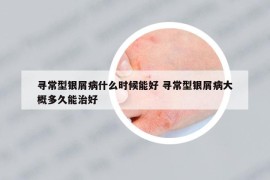 尋常型銀屑病什么時候能好 尋常型銀屑病大概多久能治好