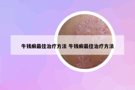 牛錢癬最佳治療方法 牛錢癬最佳治療方法