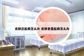 皮膚總起癬怎么辦 皮膚老是起癬怎么辦