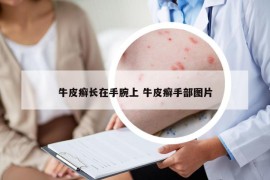 牛皮癬長(zhǎng)在手腕上 牛皮癬手部圖片