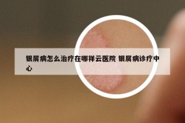 銀屑病怎么治療在哪祥云醫(yī)院 銀屑病診療中心
