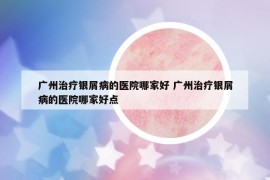 廣州治療銀屑病的醫(yī)院哪家好 廣州治療銀屑病的醫(yī)院哪家好點(diǎn)