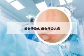 癬會(huì)傳染么 癬會(huì)傳染人嗎