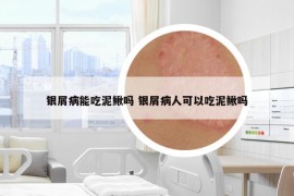 銀屑病能吃泥鰍嗎 銀屑病人可以吃泥鰍嗎