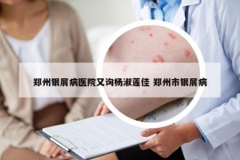 鄭州銀屑病醫(yī)院又詢楊淑蓮佳 鄭州市銀屑病