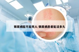 銀屑病能不能死人 銀屑病患者能活多久