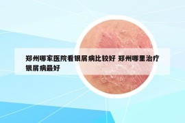 鄭州哪家醫(yī)院看銀屑病比較好 鄭州哪里治療銀屑病最好