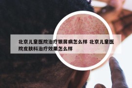北京兒童醫(yī)院治療銀屑病怎么樣 北京兒童醫(yī)院皮膚科治療效果怎么樣
