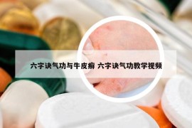 六字訣氣功與牛皮癬 六字訣氣功教學(xué)視頻