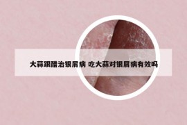 大蒜跟醋治銀屑病 吃大蒜對(duì)銀屑病有效嗎