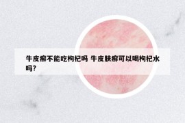 牛皮癬不能吃枸杞嗎 牛皮膚癬可以喝枸杞水嗎?