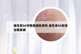 維生素b6對銀屑病有用嗎 維生素b6軟膏治銀屑病