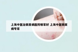 上海中醫(yī)治銀屑病醫(yī)院哪家好 上海中醫(yī)銀屑病專家