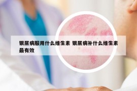 銀屑病服用什么維生素 銀屑病補(bǔ)什么維生素最有效