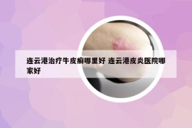 連云港治療牛皮癬哪里好 連云港皮炎醫(yī)院哪家好