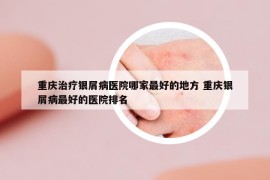 重慶治療銀屑病醫(yī)院哪家最好的地方 重慶銀屑病最好的醫(yī)院排名