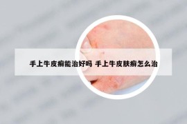 手上牛皮癬能治好嗎 手上牛皮膚癬怎么治