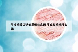 牛皮癬養(yǎng)生粥都是哪些東西 牛皮膚癬喝什么湯
