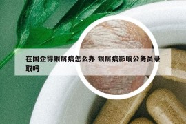 在國企得銀屑病怎么辦 銀屑病影響公務(wù)員錄取嗎