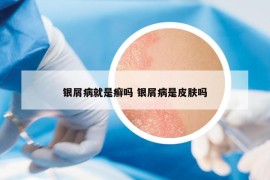 銀屑病就是癬嗎 銀屑病是皮膚嗎