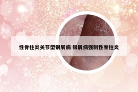 性脊柱炎關(guān)節(jié)型銀屑病 銀屑病強(qiáng)制性脊柱炎