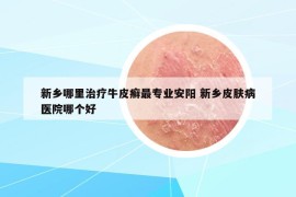 新鄉(xiāng)哪里治療牛皮癬最專業(yè)安陽 新鄉(xiāng)皮膚病醫(yī)院哪個好