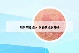 銀屑病能沾水 銀屑病沾水變紅