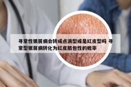 尋常性銀屑病會(huì)轉(zhuǎn)成點(diǎn)滴型或是紅皮型嗎 尋常型銀屑病轉(zhuǎn)化為紅皮膿包性的概率