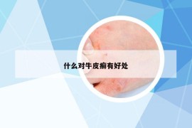 什么對(duì)牛皮癬有好處