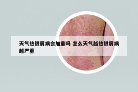 天氣熱銀屑病會(huì)加重嗎 怎么天氣越熱銀屑病越嚴(yán)重