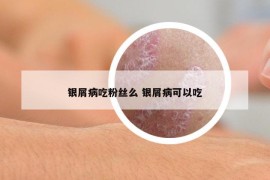 銀屑病吃粉絲么 銀屑病可以吃