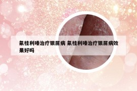 氟桂利嗪治療銀屑病 氟桂利嗪治療銀屑病效果好嗎