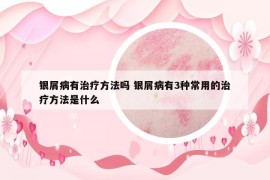 銀屑病有治療方法嗎 銀屑病有3種常用的治療方法是什么