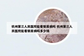杭州第三人民醫(yī)院能看銀屑病嗎 杭州第三人民醫(yī)院能看銀屑病嗎多少錢