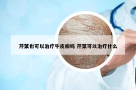 芹菜也可以治療牛皮癬嗎 芹菜可以治療什么