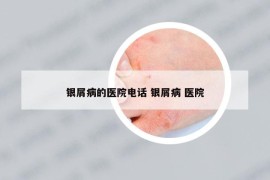 銀屑病的醫(yī)院電話 銀屑病 醫(yī)院