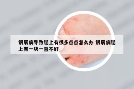 銀屑病導(dǎo)致腿上有很多點點怎么辦 銀屑病腿上有一塊一直不好