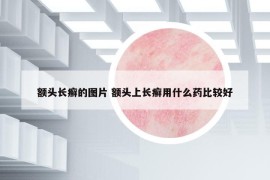 額頭長癬的圖片 額頭上長癬用什么藥比較好