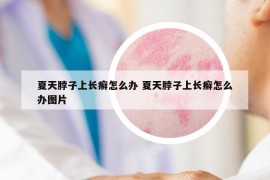 夏天脖子上長癬怎么辦 夏天脖子上長癬怎么辦圖片
