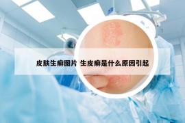 皮膚生癬圖片 生皮癬是什么原因引起