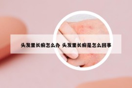 頭發(fā)里長癬怎么辦 頭發(fā)里長癬是怎么回事