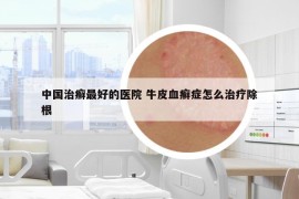 中國治癬最好的醫(yī)院 牛皮血癬癥怎么治療除根