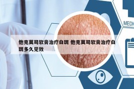 他克莫司軟膏治療白斑 他克莫司軟膏治療白斑多久見效