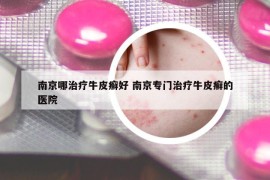 南京哪治療牛皮癬好 南京專門治療牛皮癬的醫(yī)院