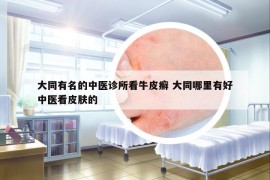 大同有名的中醫(yī)診所看牛皮癬 大同哪里有好中醫(yī)看皮膚的
