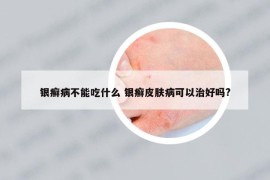 銀癬病不能吃什么 銀癬皮膚病可以治好嗎?