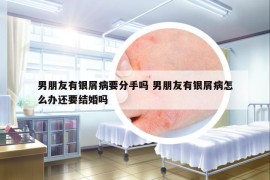 男朋友有銀屑病要分手嗎 男朋友有銀屑病怎么辦還要結婚嗎