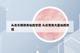 頭皮長期使用哈西奈德 頭皮使用大量哈西奈德